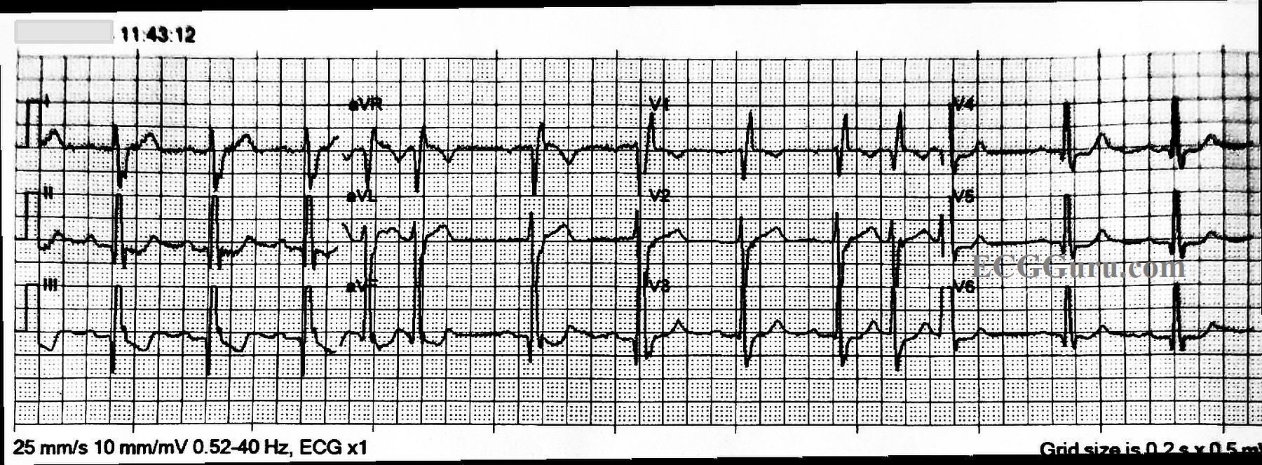 bundle of his block ecg